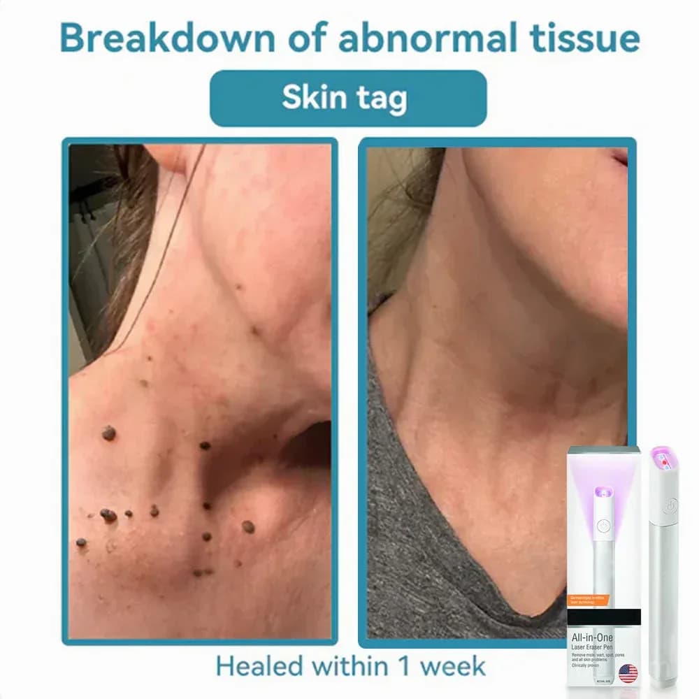 All-in-One CO₂ Laser Eraser Pen for Moles, Warts & Skin Flaws - View 12