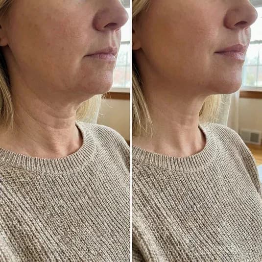 V-Lifting Mewing Band (4 Masks Per Pack) - View 8