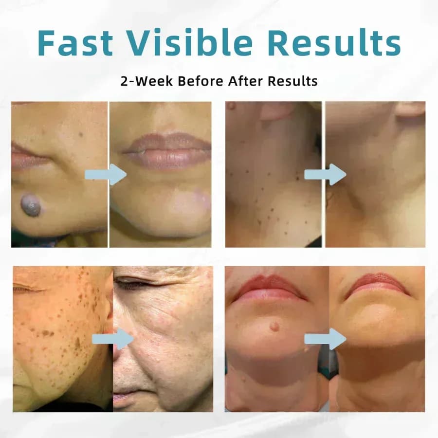 All-in-One CO₂ Laser Eraser Pen for Moles, Warts & Skin Flaws - View 6