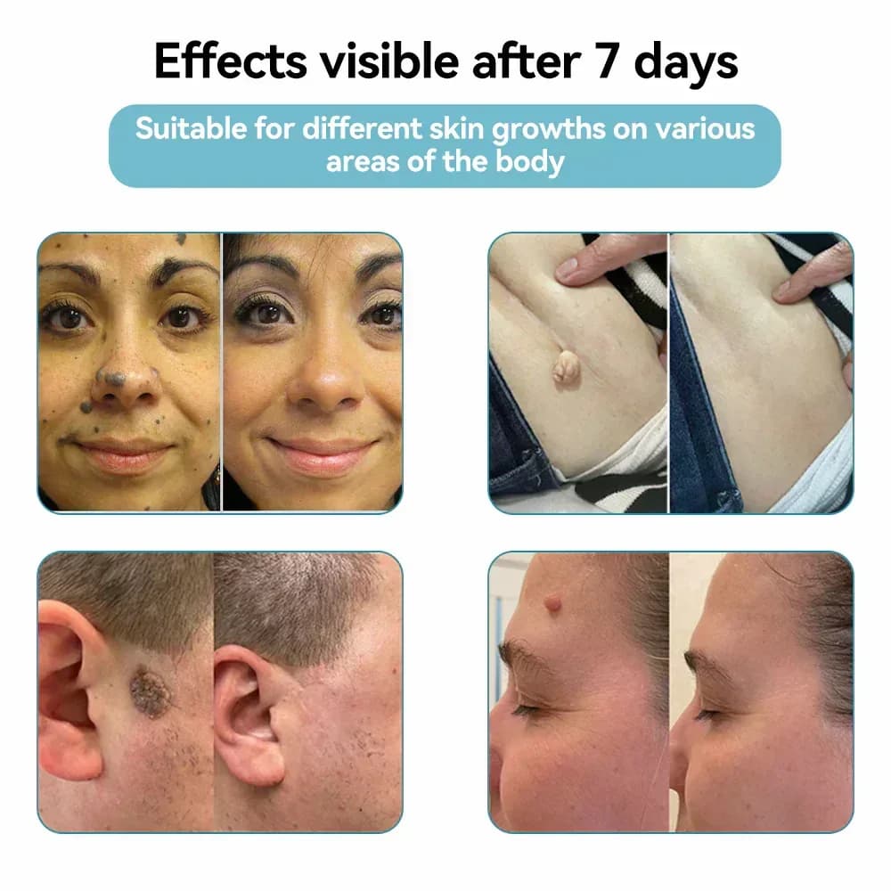 All-in-One CO₂ Laser Eraser Pen for Moles, Warts & Skin Flaws - View 5