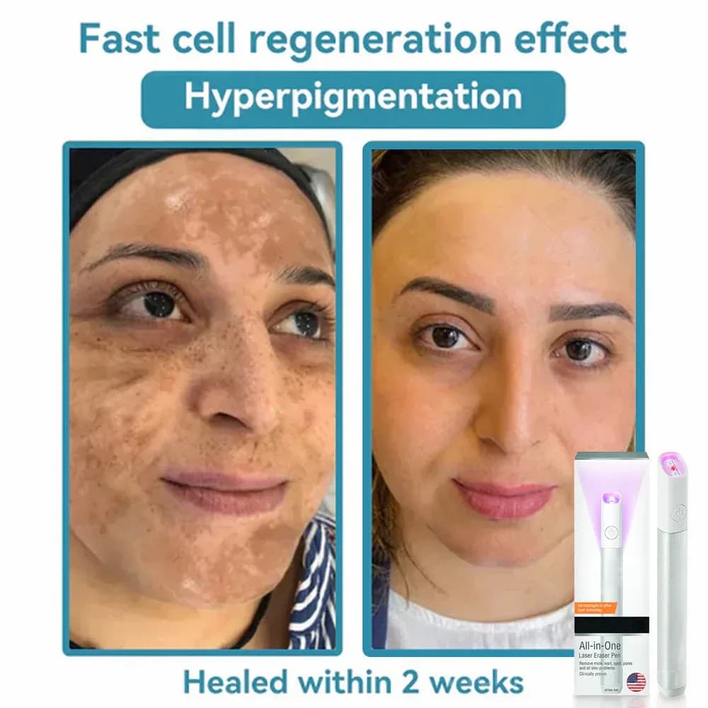 All-in-One CO₂ Laser Eraser Pen for Moles, Warts & Skin Flaws - View 10