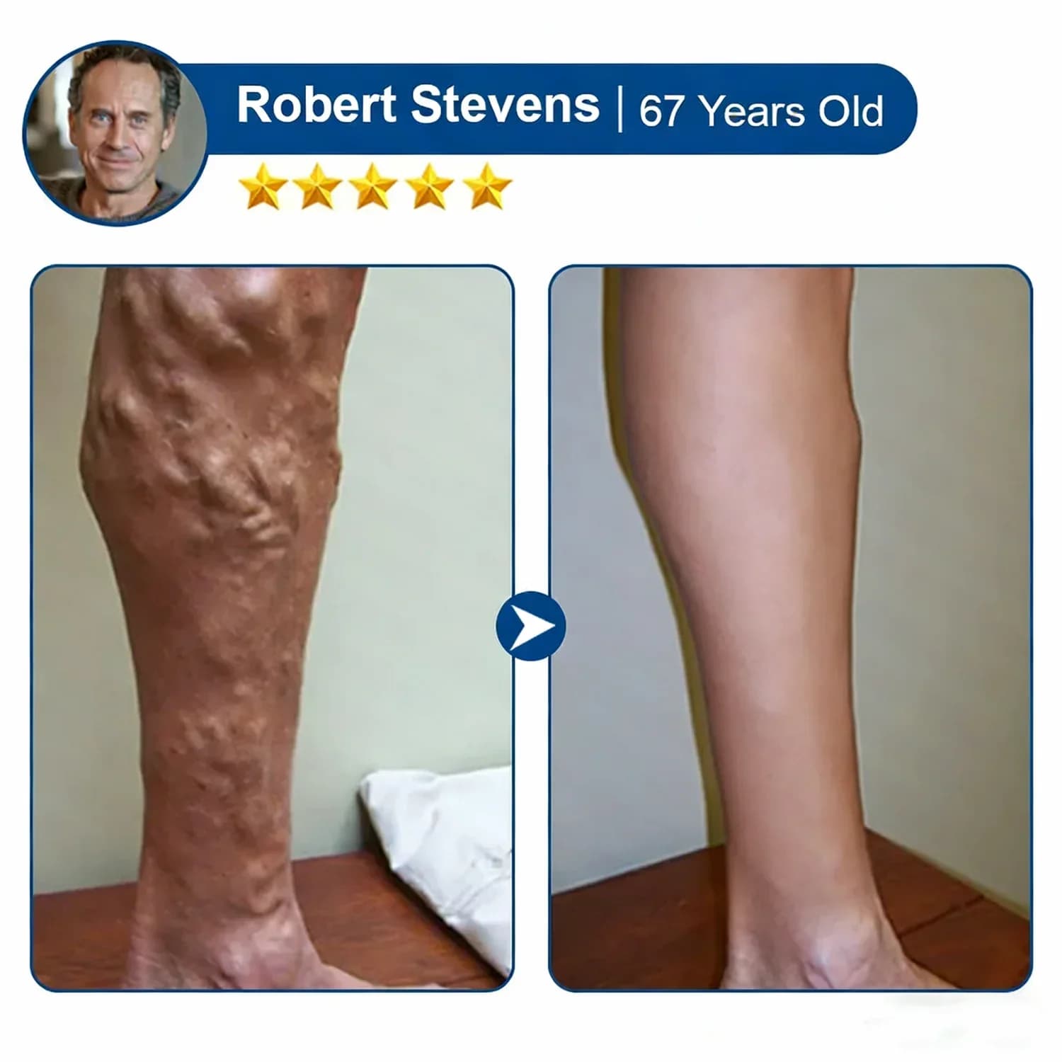 Vein Contour Microneedle Patch with Diosmin & Hesperidin, 7-Day - View 11