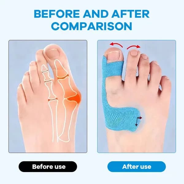 Pre-cut Bunion Corrector Kinesiology Tape - View 3